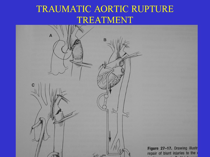 35 TRAUMATIC AORTIC RUPTURE TREATMENT DIRECT REPAIR RESECTION AND GRAFTING TREATMENT BY QUALIFIED SURGEON